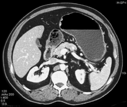 Hyperplastic Polyps - CTisus CT Scan