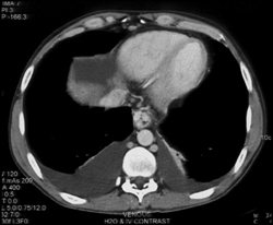 Gastric and Esophageal Varices - CTisus CT Scan