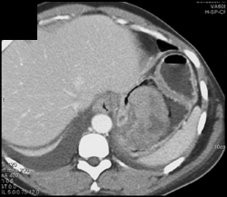 GIST Tumor - CTisus CT Scan