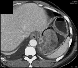 GIST Tumor - CTisus CT Scan