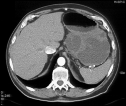 Large GIST Tumor - CTisus CT Scan