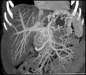 Gastric Varices - CTisus CT Scan