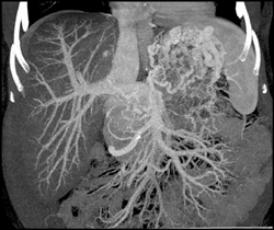 Gastric Varices - CTisus CT Scan