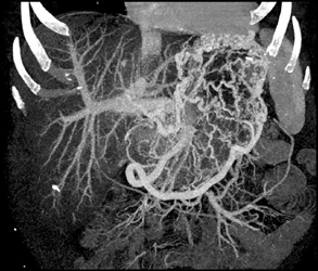 Gastric Varices - CTisus CT Scan