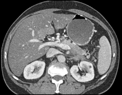 Gastric Varices - Stomach Case Studies - CTisus CT Scanning