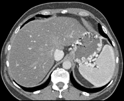 Gastric Varices - CTisus CT Scan