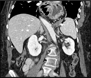 Intrathoracic Stomach - CTisus CT Scan