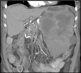 GIST Tumor - CTisus CT Scan