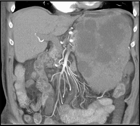 GIST Tumor - CTisus CT Scan