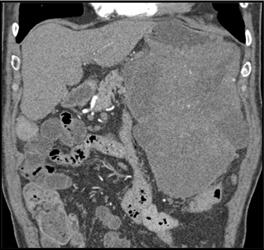 GIST Tumor - CTisus CT Scan