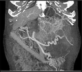 GIST Tumor - CTisus CT Scan