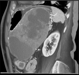 GIST Tumor - CTisus CT Scan