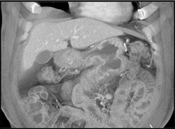 Stomach Small Bowel Fistulae Due to Gastric Cancer - CTisus CT Scan