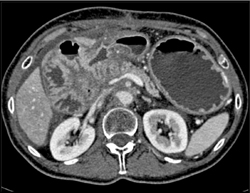 Gastric Cancer With Nodes - CTisus CT Scan