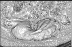 3D of Stomach - CTisus CT Scan