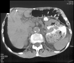 Gastric Adenocarcinoma - CTisus CT Scan