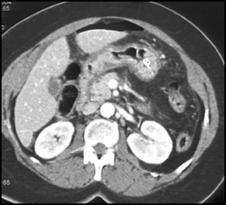 Gastric Adenocarcinoma - CTisus CT Scan