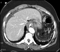 Gastric Adenocarcinoma - CTisus CT Scan