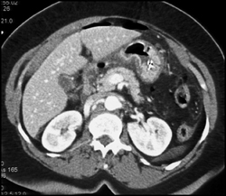 Gastric Adenocarcinoma - CTisus CT Scan