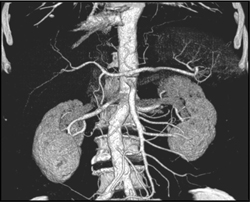 Normal Gastric Artery - CTisus CT Scan