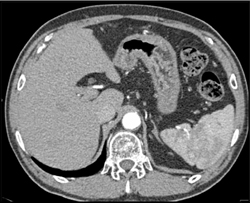 Linitis Plastica - CTisus CT Scan