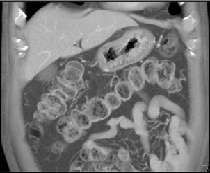 Linitis Plastica - CTisus CT Scan