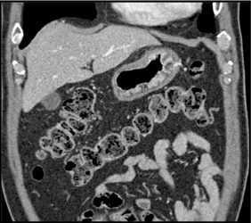 Linitis Plastica - CTisus CT Scan