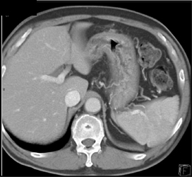 Linitis Plastica - CTisus CT Scan