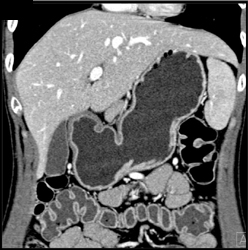 Normal Stomach - CTisus CT Scan