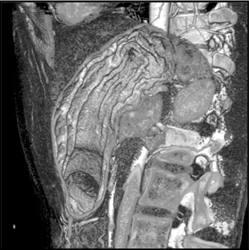 Normal Folds - CTisus CT Scan