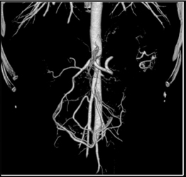 Normal Mesenteric Arcade - CTisus CT Scan