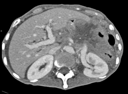 Gastric Cancer With Local Spread and Carcinomatosis - CTisus CT Scan