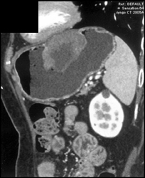 GIST Tumor - CTisus CT Scan