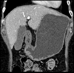 Gastric Antral Carcinoma - CTisus CT Scan