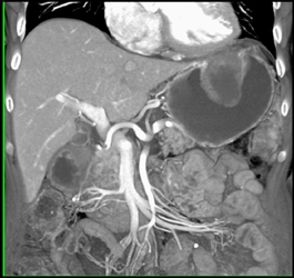 GIST Tumor - CTisus CT Scan