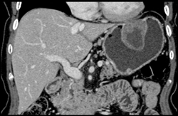 GIST Tumor - CTisus CT Scan