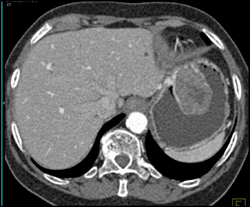 GIST Tumor - CTisus CT Scan