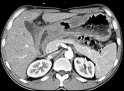 Gastric Lymphoma - CTisus CT Scan