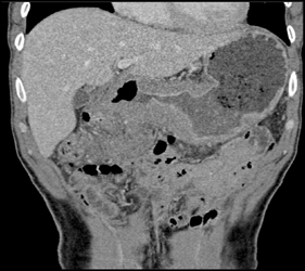 Gastric Lymphoma - CTisus CT Scan