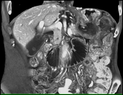 Recurrent Gastric Cancer in Gastric Remnant - CTisus CT Scan