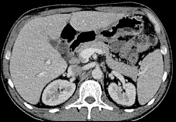 Gastric Cancer - CTisus CT Scan