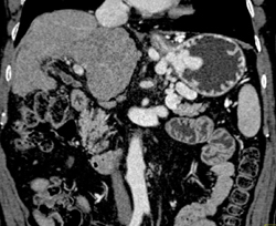 Gastric Varices - CTisus CT Scan