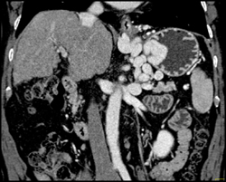 Gastric Varices - CTisus CT Scan