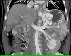 Gastric Varices - CTisus CT Scan