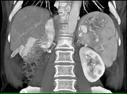 Gastric Varices - CTisus CT Scan