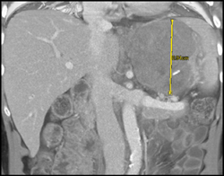 GIST Tumor With Ulceration - CTisus CT Scan