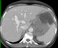 GIST Tumor With Ulceration - CTisus CT Scan