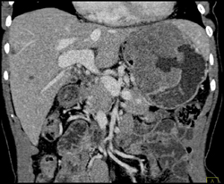 GIST Tumor With Ulceration - CTisus CT Scan