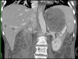 GIST Tumor With Ulceration - CTisus CT Scan