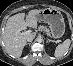 Gastric Cancer - CTisus CT Scan